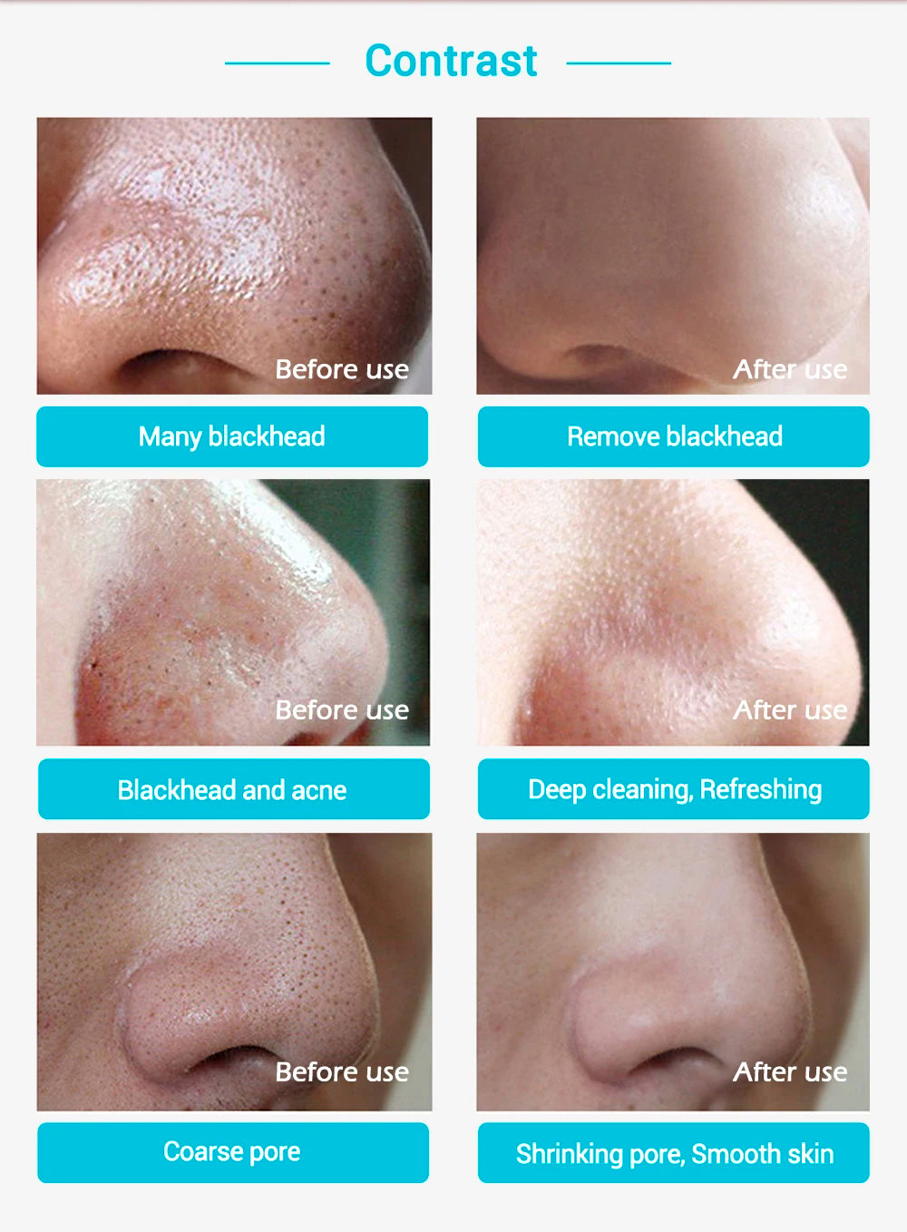 Anti Acne Treatment Deep Cleansing