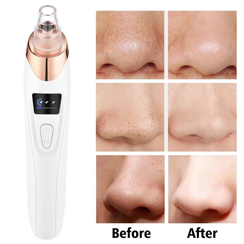 Vacuum Pore Facial Cleaner