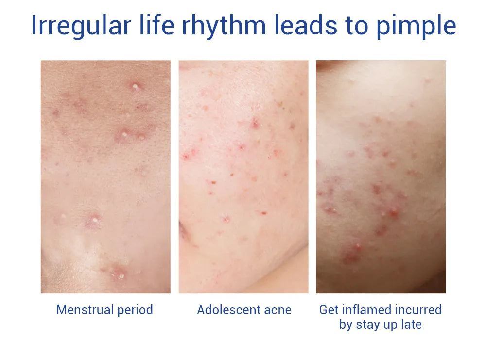 LANBENA Acne Pimple Patch